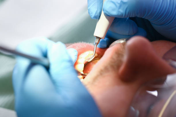 Best Broken or Cracked Tooth Emergency Dentist in Spindale, NC