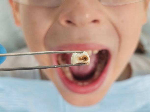 Best Urgent Dental Care for Toothache in Spindale, NC